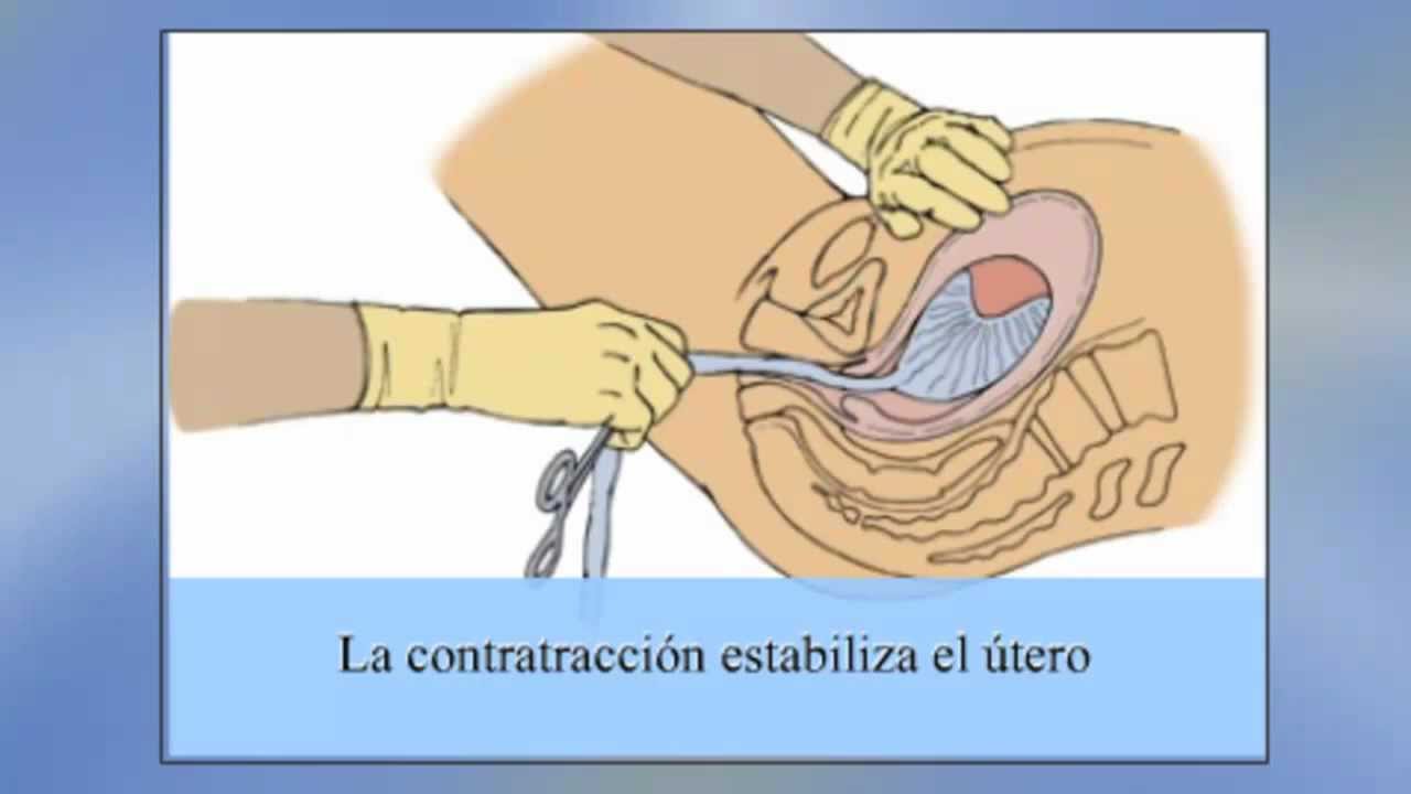 Manejo Activo